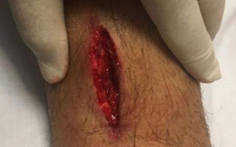 Roma-speler toont zijn vreselijke blessure