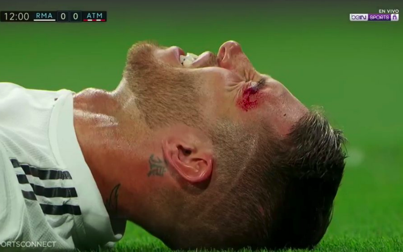 Auwch! Zo ziet Sergio Ramos er na stevig duel tijdens Real-Atlético uit