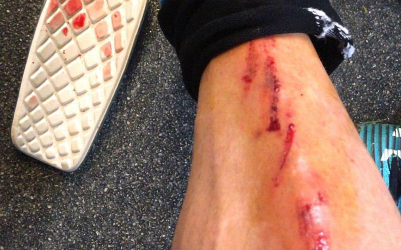 Club Brugge-speler toont zijn been na aanslag tegen Charleroi