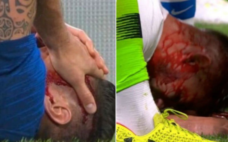 Olivier Giroud loopt verschrikkelijke blessure op vlak voor WK